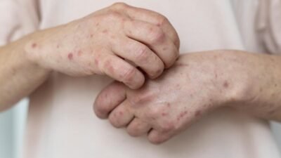 “Kasus Campak di Jabar Meningkat Drastis, Petahana Wajib Waspadai”